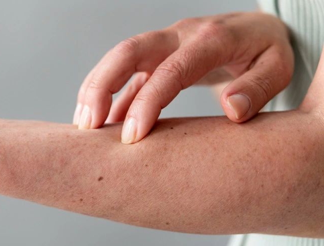 Diskes Pekanbaru Imbau Waspadai Skabies, Penyakit Kulit Menular yang Ganggu Aktivitas