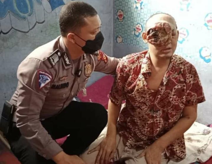 Tumor Ganas Hampir Menutup Semua Wajahnya, Polisi Bantu Carikan Pendonasi 