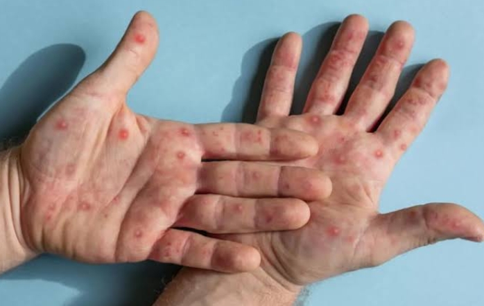 Antisipasi Penyebaran Wabah Monkeypox, Berikut Langkah Diskes Pekanbaru