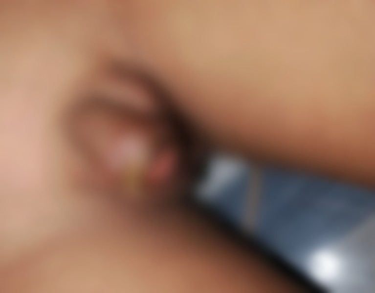 Bocah 9 Tahun di Pelalawan Diduga Jadi Korban Malapraktik Saat Khitan, Bidan Tak Miliki Izin Praktik